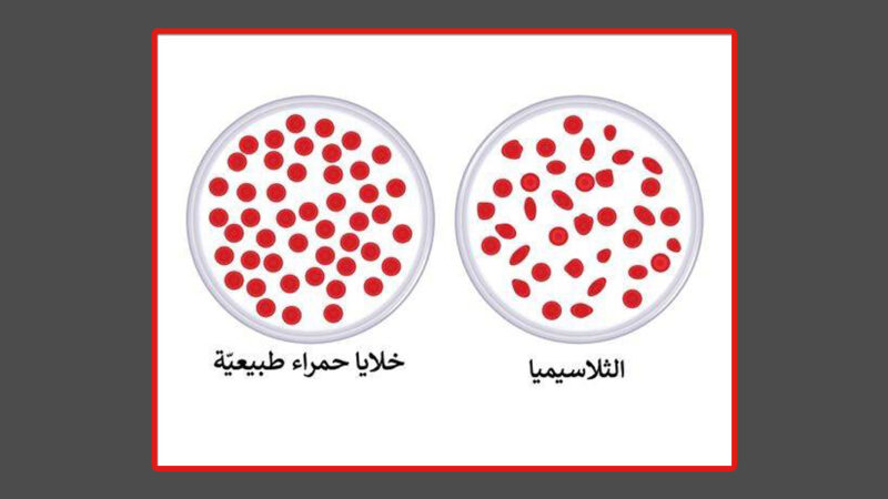 الثلاسيميا: مرض وراثي وتأثيره على الصحة