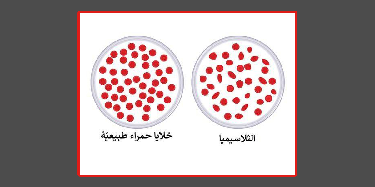 الثلاسيميا: مرض وراثي وتأثيره على الصحة