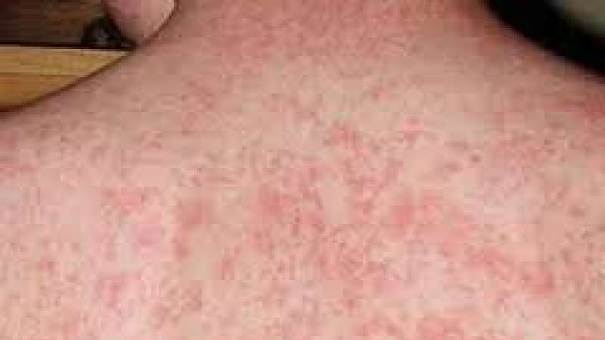 الحصبة: مرض فيروسي قابل للوقاية