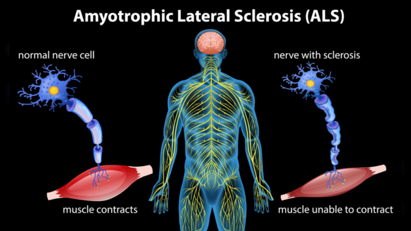 مرض التصلّب الجانبي الضموري (ALS)